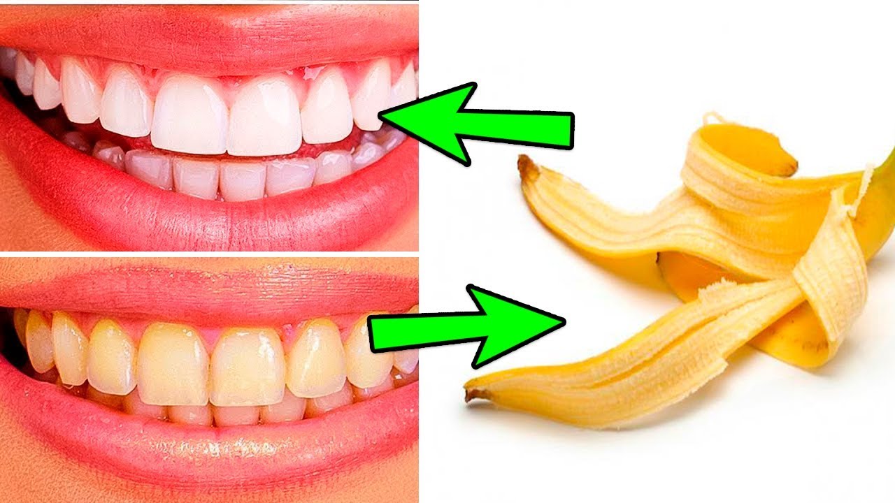 maxresdefault 8415 - Как Быстро Отбелить Зубы В Домашних Условиях (варианты для каждого) Красивые зубы